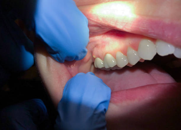 Best Emergency Dental Care for Broken or Chipped Teeth in Vale, OR